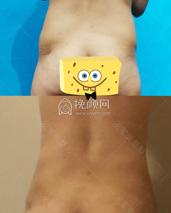 广州吸脂哪个医生技术好?【功课大全】