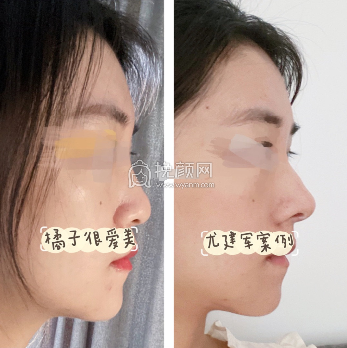医院医生攻略 | 北京隆鼻医院医生测评