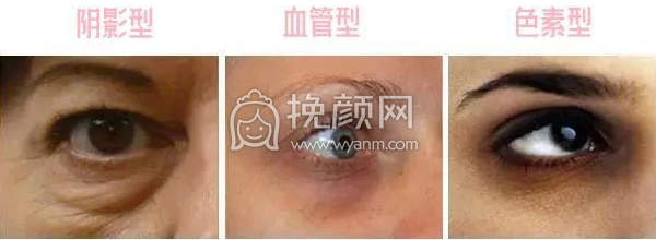 较全黑眼圈祛除医美项目教你怎么办!