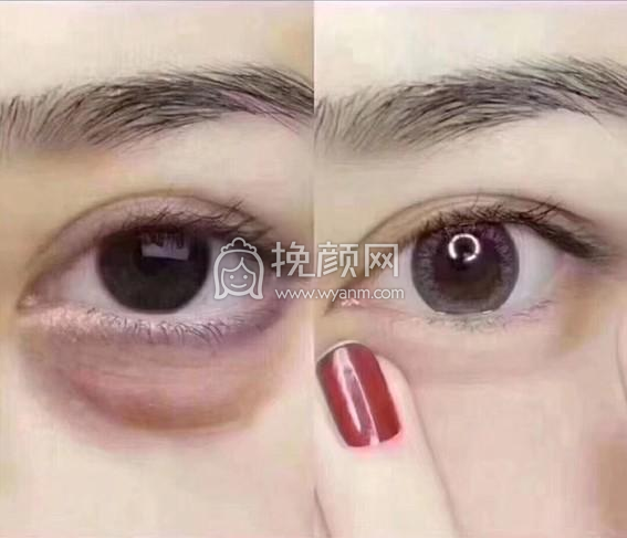 较全黑眼圈祛除医美项目教你怎么办!