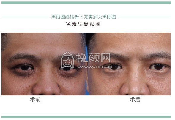 较全黑眼圈祛除医美项目教你怎么办!