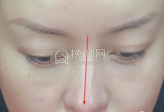 隆鼻系列干货| 你是何种鼻+常见隆鼻方式优缺点