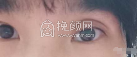 双眼皮术后“肉条”是怎么形成的,应该怎么处