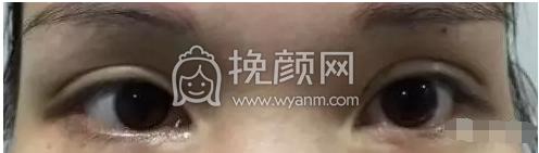 谁说眼窝凹陷就一定要填充脂肪？【宽深双眼皮