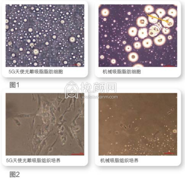 深圳鹏爱的5G光雕吸脂技术好不好?