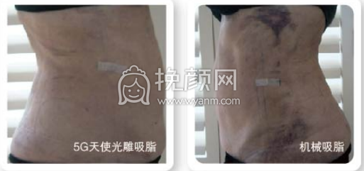 上海安缦的5G光雕吸脂技术好不好?