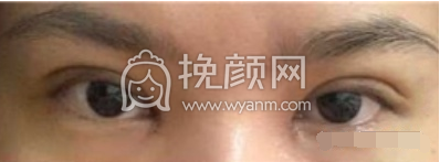泉州做双眼皮哪个医生好?【盘点】
