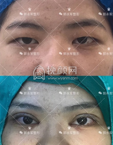 泉州做双眼皮哪个医生好?【盘点】