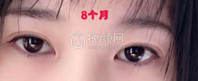 济宁有做双眼皮刘郭、高凤林、代廷虎果怎么