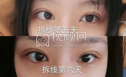 济宁有做双眼皮刘郭、高凤林、代廷虎果怎么