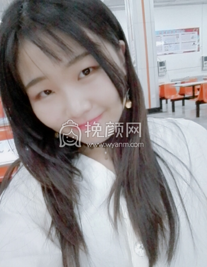 济宁人民医院高凤林做双眼皮好不好?【案例|价