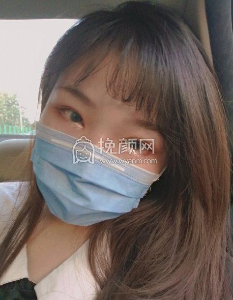 济宁人民医院高凤林做双眼皮好不好?【案例|价