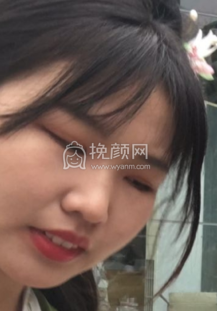 济宁人民医院高凤林做双眼皮好不好?【案例|价