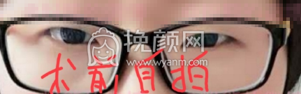 济宁代廷虎医生全切双眼皮案例|价格|果图