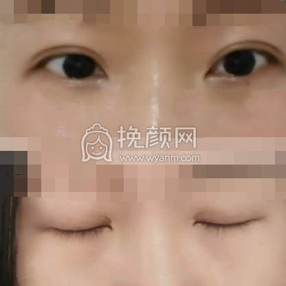 济宁代廷虎医生全切双眼皮案例|价格|果图