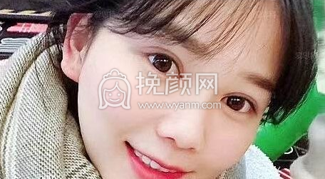 衡阳爱思特的双眼皮做的怎么样?