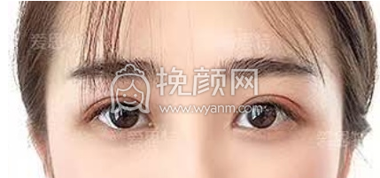 衡阳爱思特的双眼皮做的怎么样?
