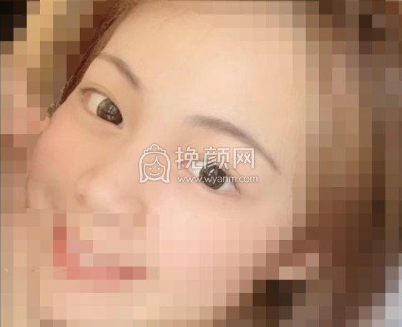 衡阳爱思特的双眼皮做的怎么样?