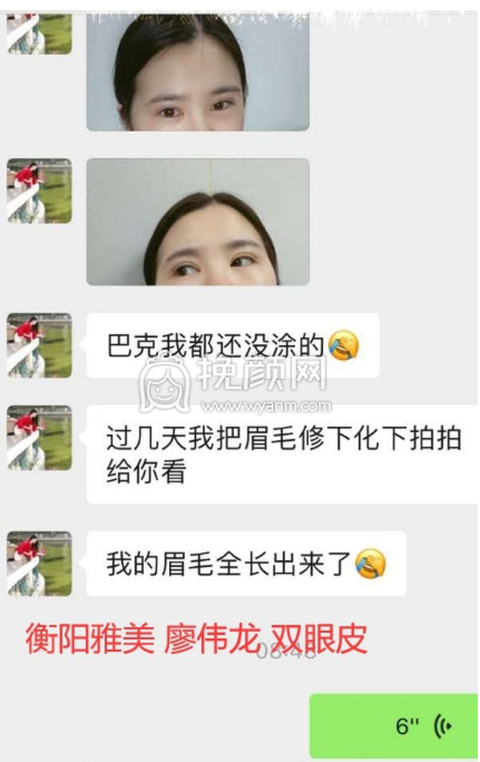 衡阳爱思特的双眼皮做的怎么样?