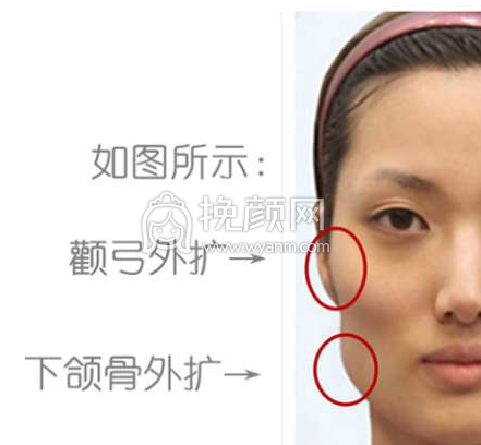 颧骨颧弓系列干货|轮廓不流畅的脸型该怎么办?