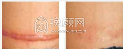 上海九院梁奕敏疤痕修复案例|价格|果