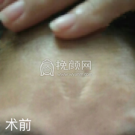 上海九院梁奕敏疤痕修复案例|价格|果