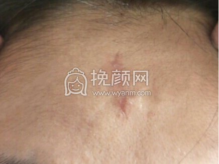 上海九院梁奕敏疤痕修复案例|价格|果