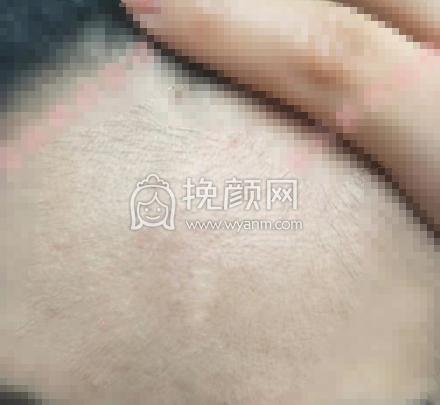 上海九院梁奕敏疤痕修复案例|价格|果