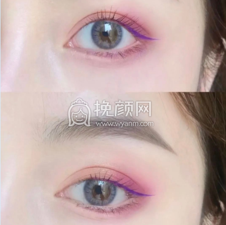 我可以做×××明星同款双眼皮吗?