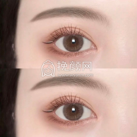我可以做×××明星同款双眼皮吗?