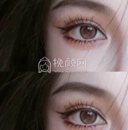 我可以做×××明星同款双眼皮吗?