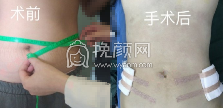 长沙梵童陈仕文多维水溶腰腹大腿吸脂案例|果