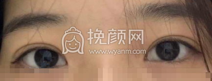 武汉思美研孔伟韩式三点双眼皮手术案例|果
