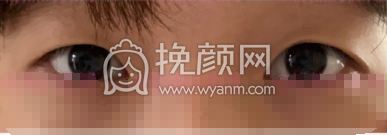 武汉思美研孔伟韩式三点双眼皮手术案例|果