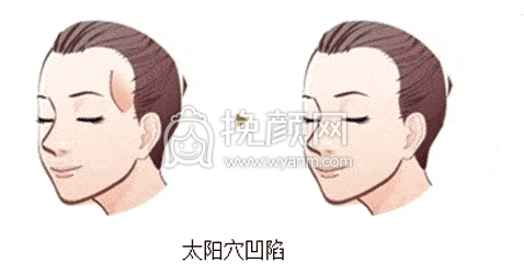 太阳穴凹陷显老显凶怎么办?
