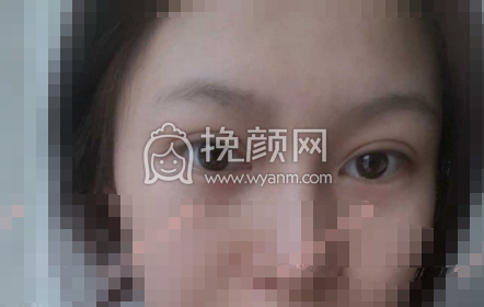 襄阳伊莱美医院王月华眼部手术果|案例|价格