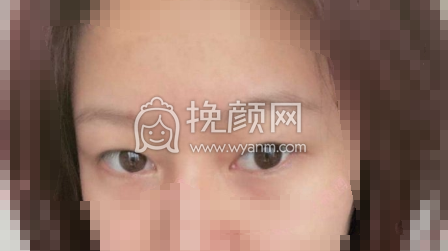 襄阳伊莱美医院王月华眼部手术果|案例|价格