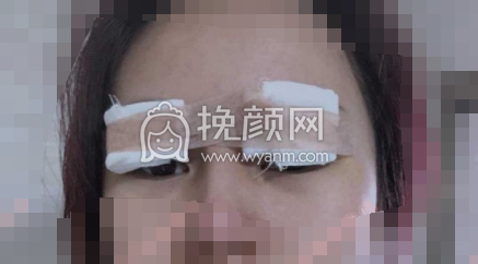 襄阳伊莱美医院王月华眼部手术果|案例|价格