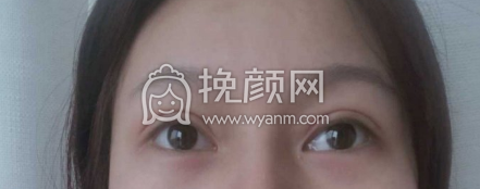 襄阳伊莱美医院王月华眼部手术果|案例|价格