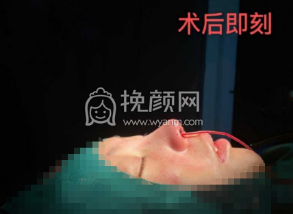 长沙欣颜田毅膨体隆鼻部手术案例|果|价格