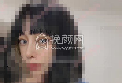 长沙欣颜田毅膨体隆鼻部手术案例|果|价格