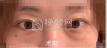 武汉协和医院钟爱梅内切眼袋+眶隔释放案例|果