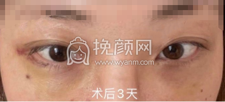 武汉协和医院钟爱梅内切眼袋+眶隔释放案例|果