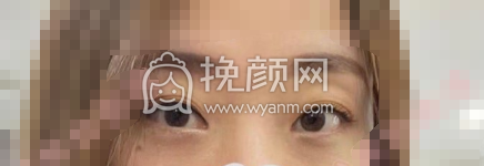 武汉协和医院钟爱梅内切眼袋+眶隔释放案例|果