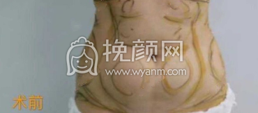 杭州新清吟冀宇半身吸脂术案例|果|价格