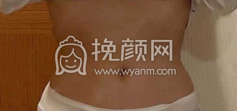 杭州新清吟冀宇半身吸脂术案例|果|价格