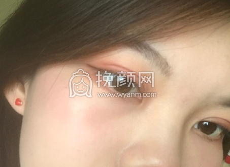 上海九院周一雄双眼皮全切案例|果|价格