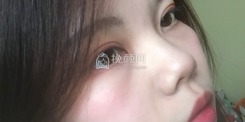 上海九院周一雄双眼皮全切案例|果|价格