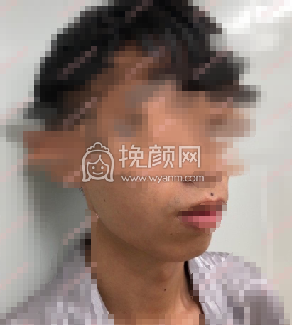 成都美熹医院刘家亘硅胶垫下巴案例|果|价格