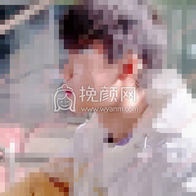 成都美熹医院刘家亘硅胶垫下巴案例|果|价格
